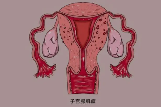 Uterus Fibroids in the women case study