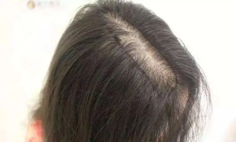 Women's long-term hair loss will lead to wider hair seams and less hair volume? 