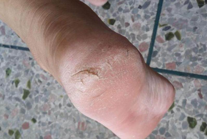  What is the cause of cracked heels?