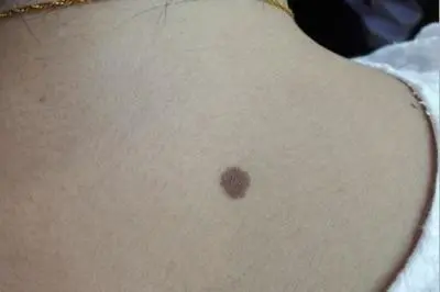 what  is the reason to getting black moles