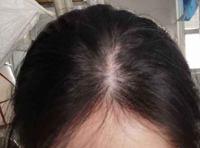 Women's long-term hair loss will lead to wider hair seams and less hair volume? 