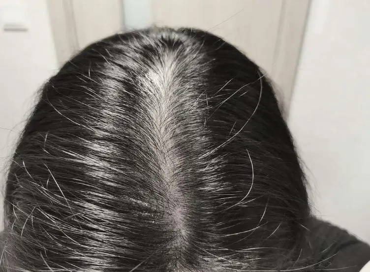 Women's long-term hair loss will lead to wider hair seams and less hair volume? 