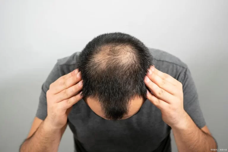 How soon can I go to work after a hair transplant