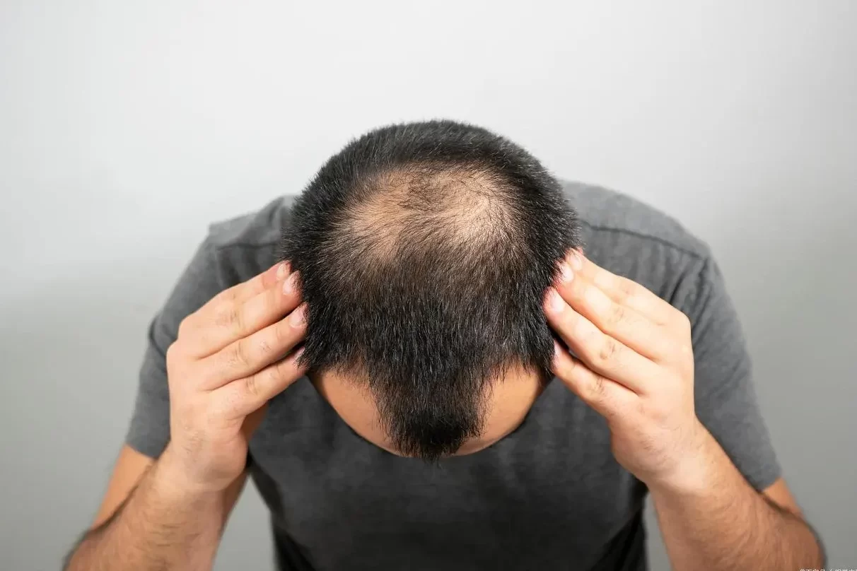 How soon can I go to work after a hair transplant