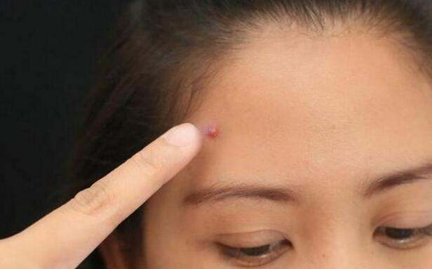 How to remove pimple and acne from my face  