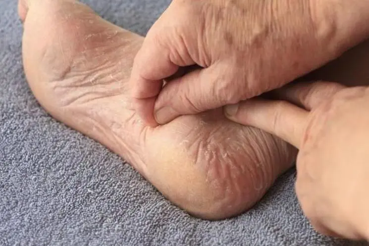 How to relief from dry and cracked heel