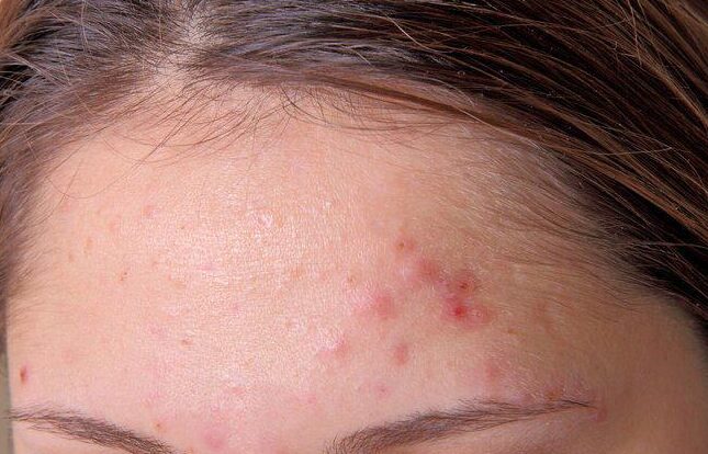 What are the reasons for the recurrence of acne?