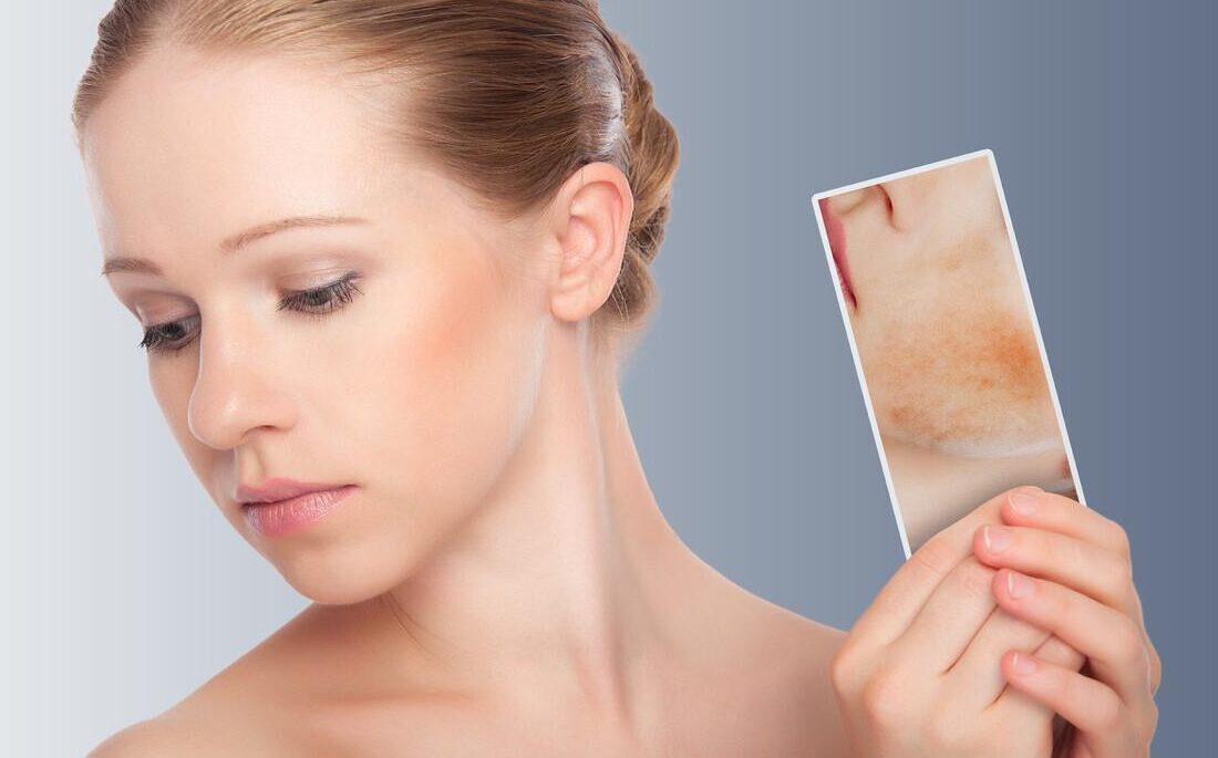 Damaged skin barrier is prone to a vicious cycle