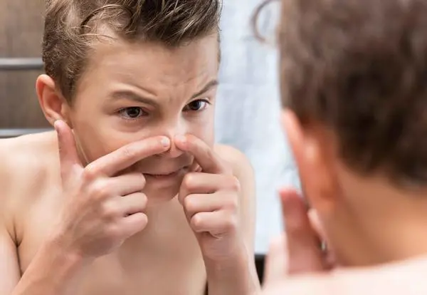 Best tips to remove pimple 