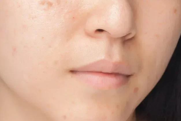 how to remove acne or pimple from my face