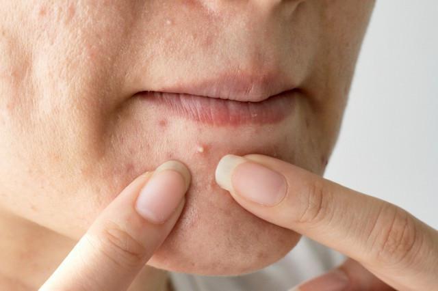 What to do about the three common types of red swollen pimples