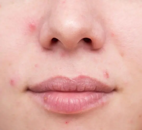 4 tricks to remove pimple on face