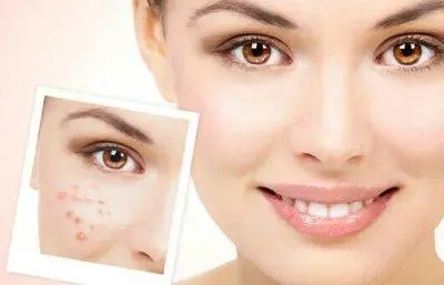 How to analyze adult acne?