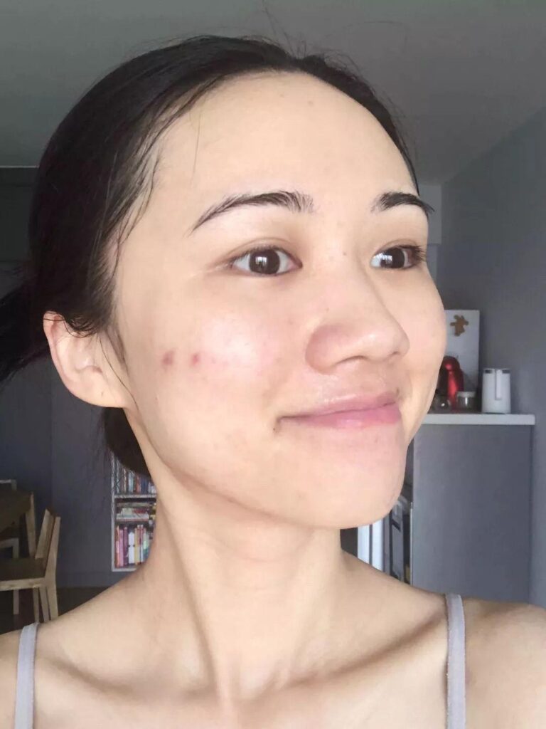 Still getting pimples after puberty?  How to analyze adult acne?