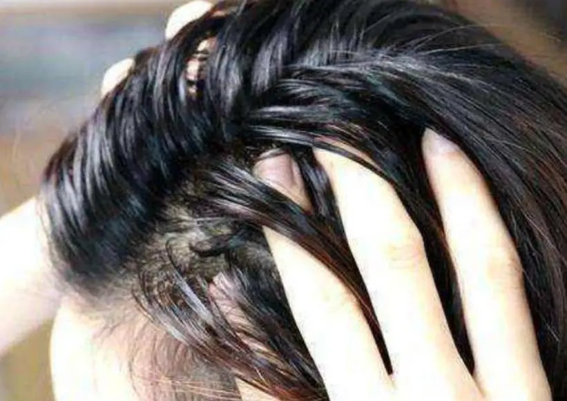 how to reduce dandruff