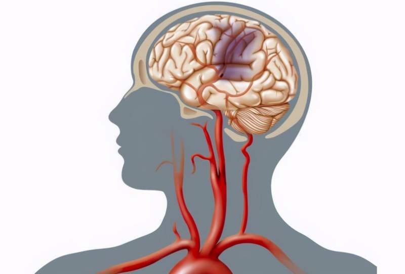 How to recover from cerebral infarction to prevent recurrence