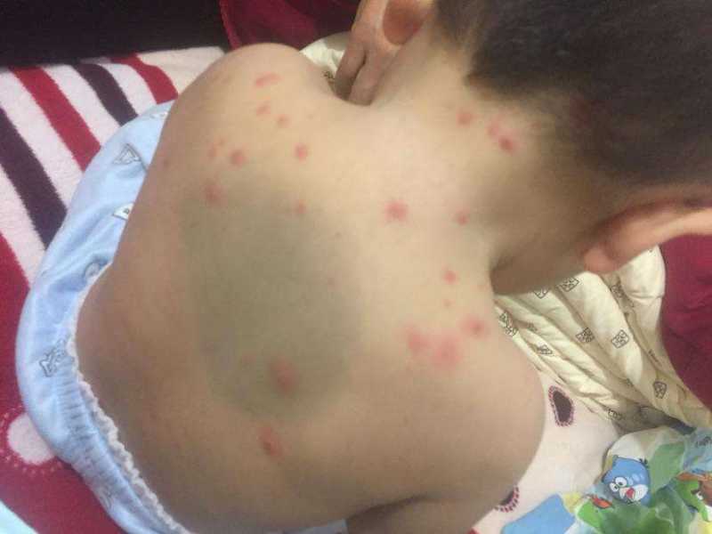 What should I do if my child has chickenpox