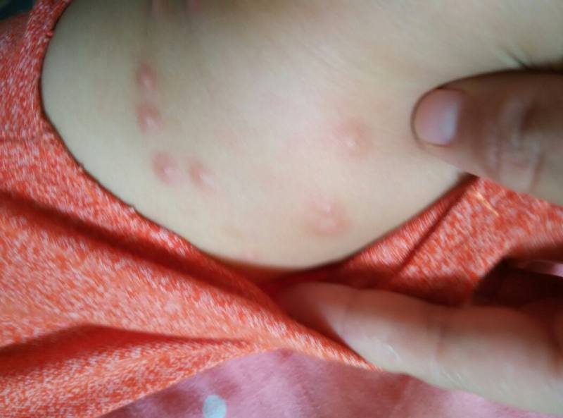 how long does chicken pox itching last