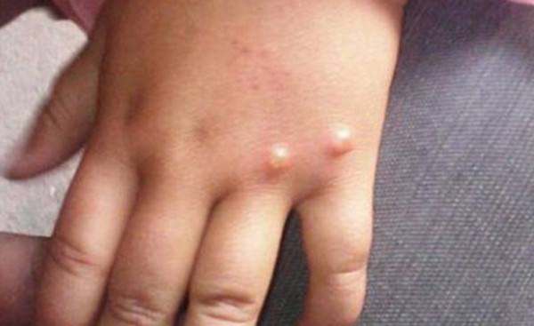 What should I do if my child has chickenpox