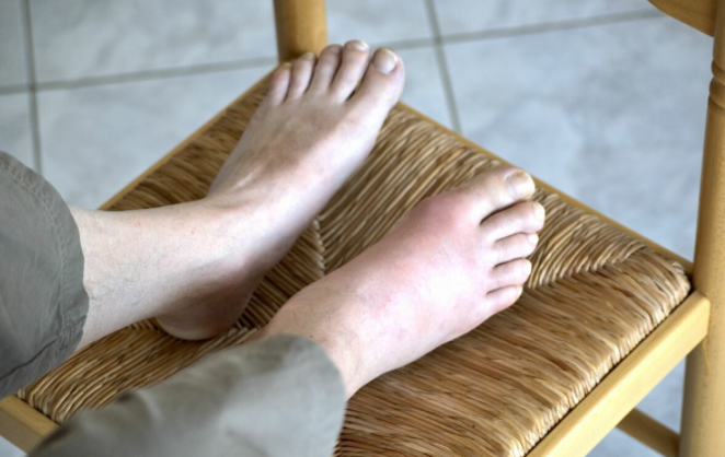 What are the absolute contraindications to gout in diet