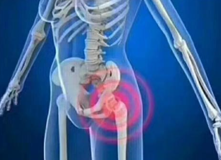 How to recover arthritis hip pain at home