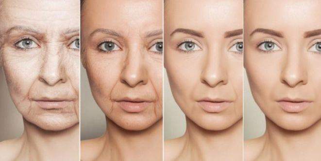 What is the anti-wrinkle principle of Botox?