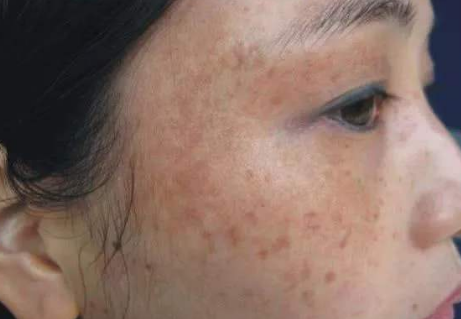 How to get rid of freckles and wrinkle from face best tips for women to remove freckles 