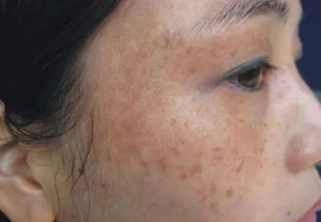 How to get rid of freckles and wrinkle from face best tips for women to remove freckles