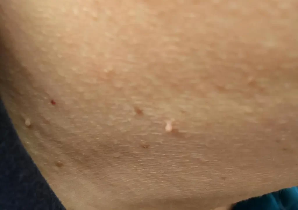 What are the "little meat particles" on the neck and armpits?