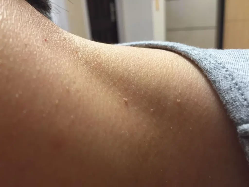 What are the "little meat particles" on the neck and armpits?