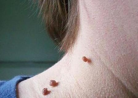 What are the little meat particles on the neck and armpits and how to remove small particle easily