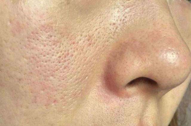 Permanent home remedy for open pores