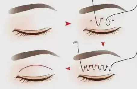 What to do with sagging eyelids