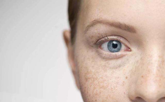 How to get rid of freckles permanently at home
