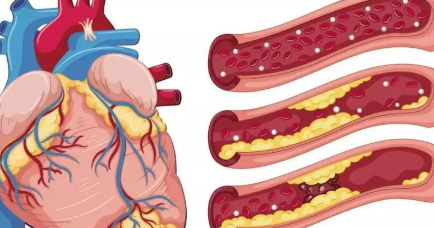 Are patients with coronary heart disease suitable for exercise