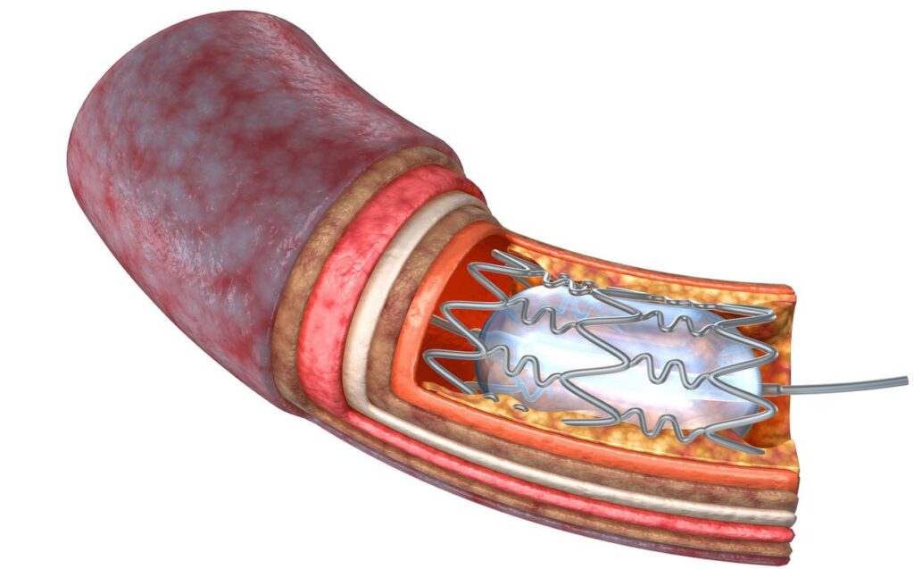 What is the best diet to lower cholesterol and triglycerides?