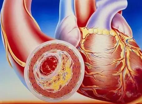  What are the top 5 risk factors of arteriosclerosis 