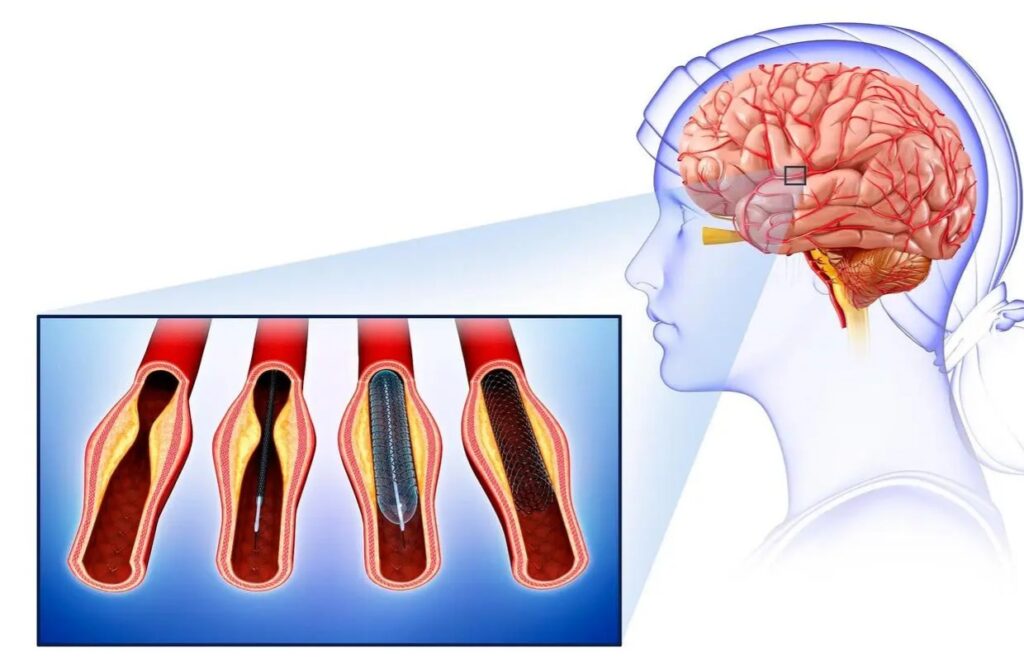 3.Cerebral arteriosclerosis