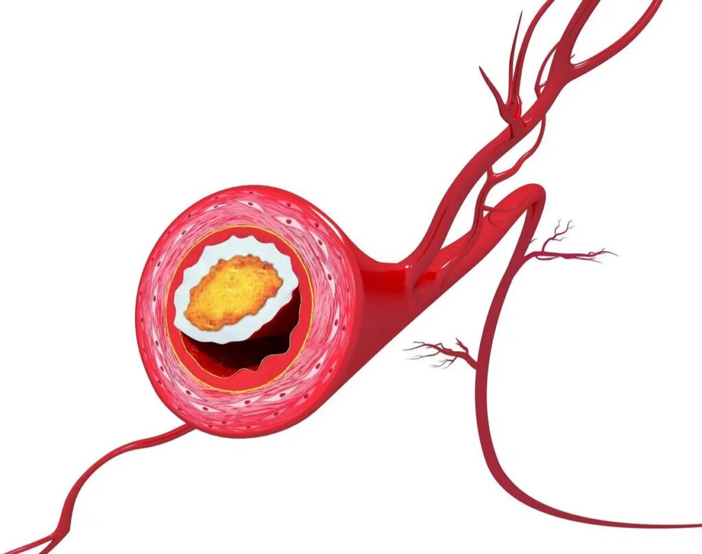 4.Renal arteriosclerosis