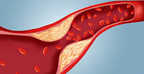 What to do with elevated LDL cholesterol?