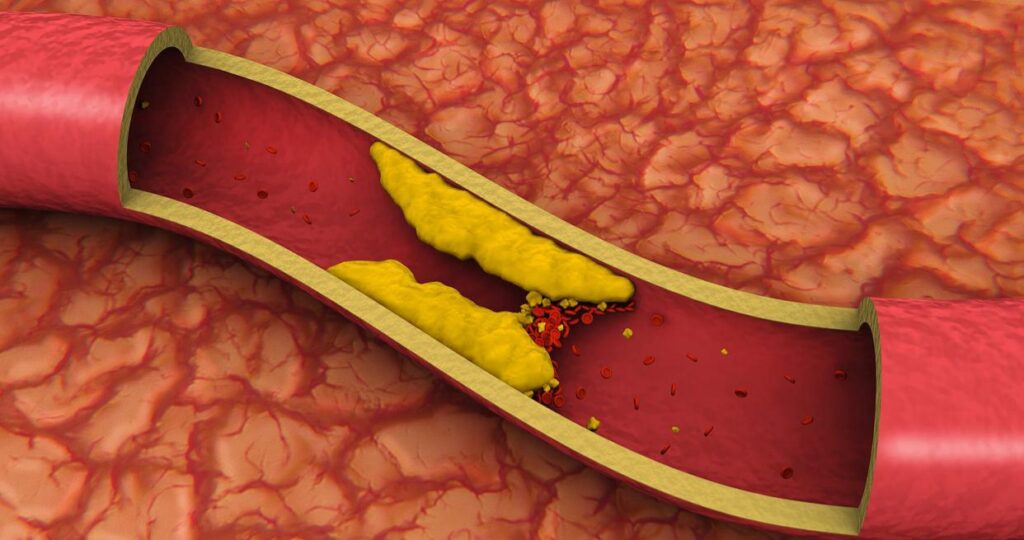 What 3 steps can a patient take to prevent atherosclerosis 