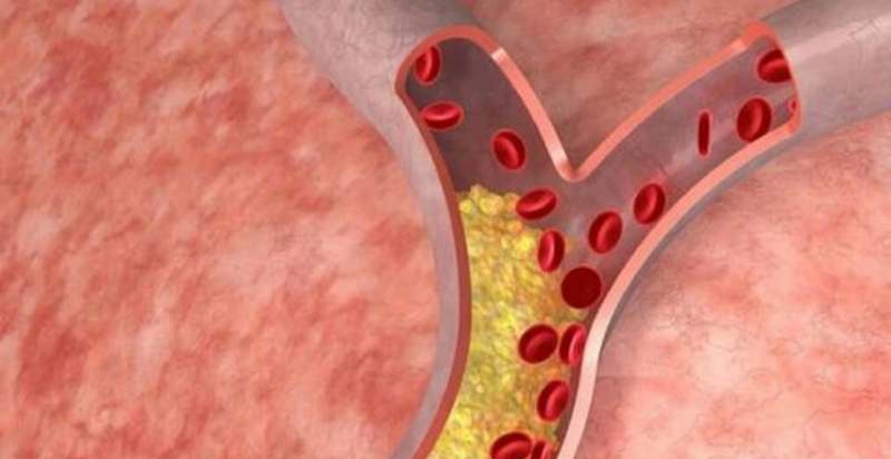 Carotid plaque treatment considerations