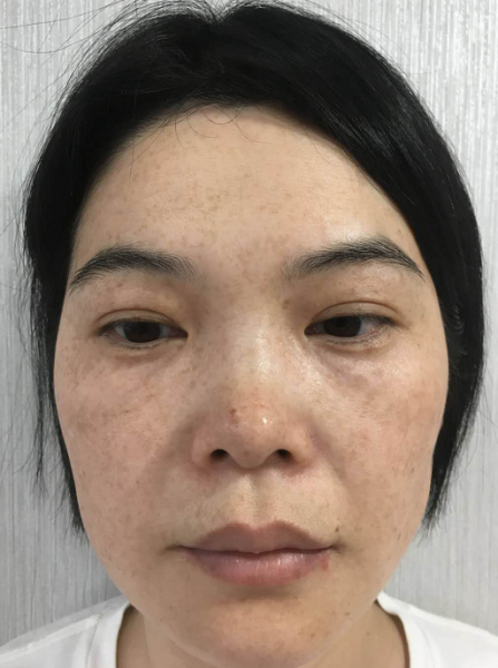 How to get rid of chloasma on face?