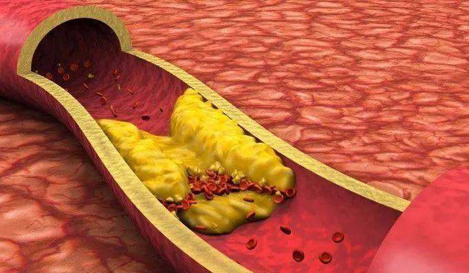 How to treat Carotid plaque and what is the main cause Carotid plaque?  