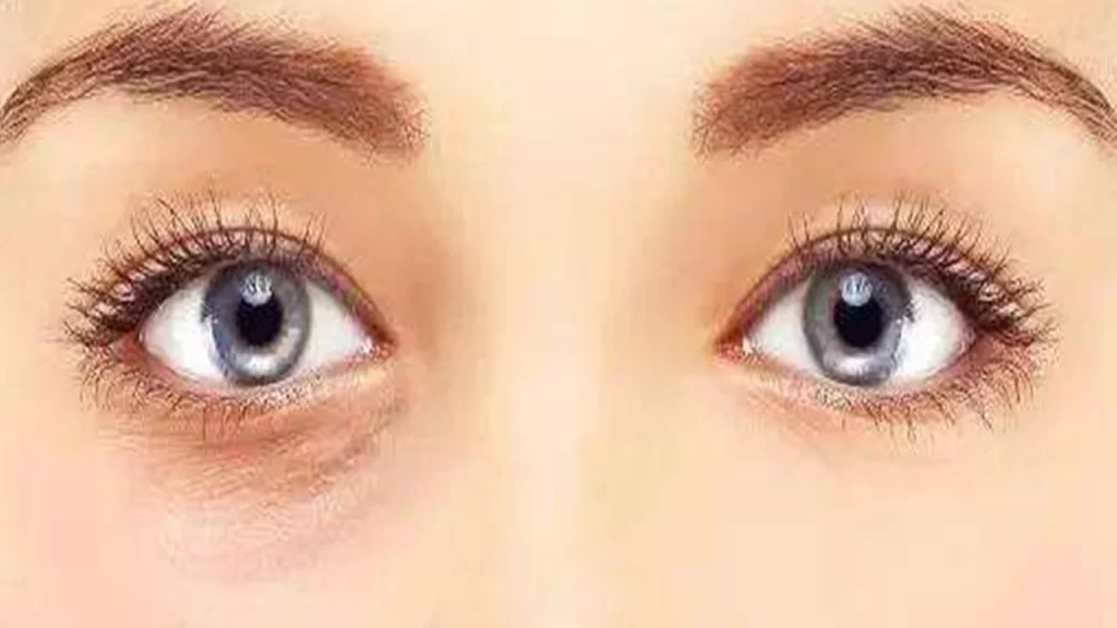 What are the difference between blood stasis type dark circles and melanin dark circles?