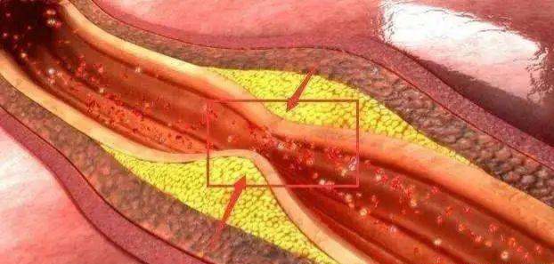 How to treat Carotid plaque and what is the main cause Carotid plaque?  