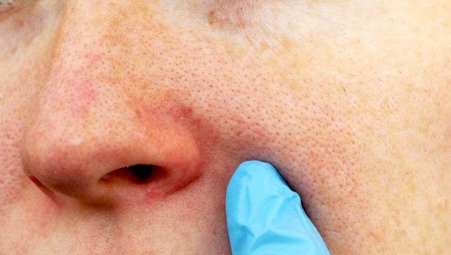 how to restore large pore 