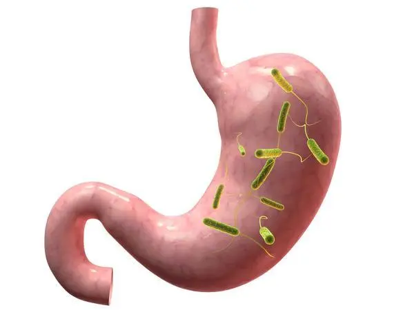 Helicobacter pylori infection