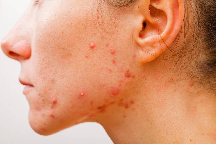 How to treat endocrine acne naturally at home?