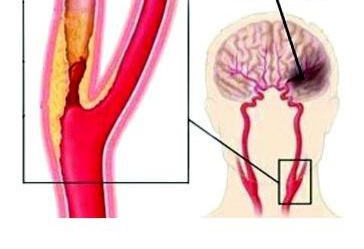 5 diet for carotid artery disease?